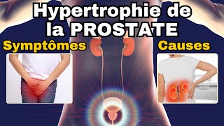 SYMPTÔMES les plus fréquents de lHYPERTROPHIE BENIGNE DE LA PROSTATE HBP [upl. by Madelaine]