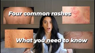 Four common rashes and everything you need to know about them [upl. by Rednave]