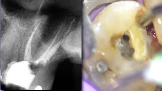 Molar Root Canal Treatment w Palatal Nerve Removal  Mesial Decay Molar Access Preparation [upl. by Tim977]