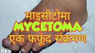 Mycetoma in hindi [upl. by Strander]