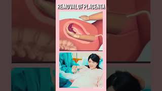 Removal of placenta fetalmovement bodypart baby cutebaby shorts [upl. by Godwin208]