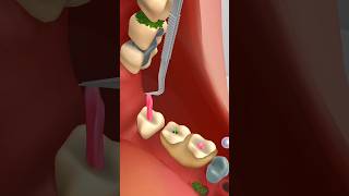 teeth cleaning  treatment animation video kidsvideo animationvideo asmrvideo shortvideo [upl. by Kohcztiy]