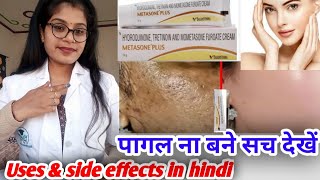 Metasone plus cream honest review Metasone plus cream benefits Uses amp side effects in hindi [upl. by Marceau]