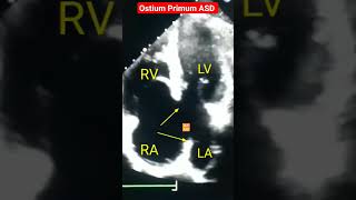 Ostium Primum ASD l Hole in Heart l Echo asd Echo shorts [upl. by Burch791]