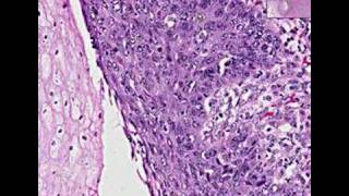 Histopathology EsophagusSquamous cell carcinoma [upl. by Mandelbaum]