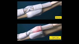 Trigger finger  a unique Ultrasound feature [upl. by Nhguav]