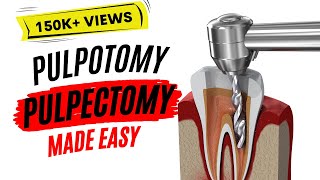 Pulpotomy and Pulpectomy  PEDIATRIC DENTISTRY [upl. by Shaefer]