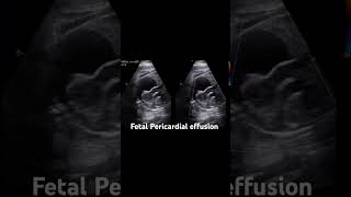 Fetal Pericardial Effusion echocardiography pediatriccardiology congenitalheartdefect fetalecho [upl. by Leandra378]