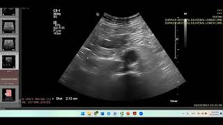 Atherosclerosis with ulcerated plaques showing triphasic waveform Check Iliac vessels Doppler case [upl. by Enoj]