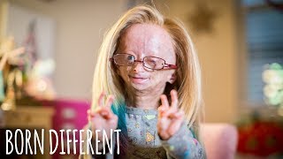 Adalia Rose The Girl Who Ages Too Fast  BORN DIFFERENT [upl. by Cassi795]