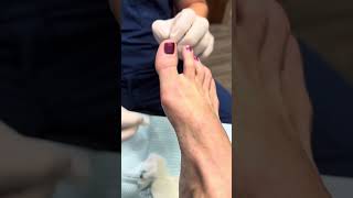 Aspiration of a cyst in the foot [upl. by Ylla694]