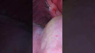 Tonsil stone removal gone horribly bad [upl. by Pleasant961]