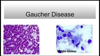 Gaucher Disease [upl. by Ymmak475]