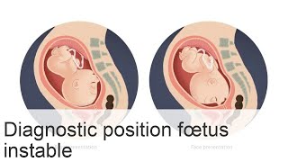 Signification et risques de la position instable du fœtus pour la maman et le bébé [upl. by Casilde]