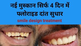 SMILE CORRECTION सामने के दांतों का 4 दिन में इलाज fluorosis teeth correction smile makeover [upl. by Chelton]