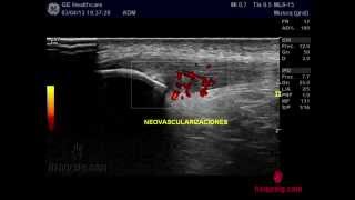 Tratamiento Tendinitis Rotuliana con EPI  Electrólisis Percutánea Intratisular [upl. by Giacomo]