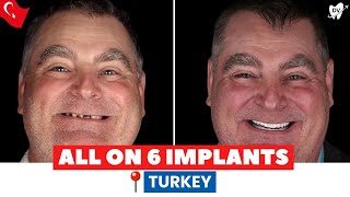 All on 6 Dental Implants in Turkey Couple Shares Their Interesting Experience [upl. by Alderman123]