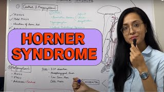 HORNER syndrome [upl. by Donall]