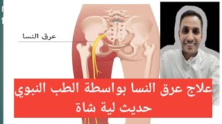 تجربة علاج عرق النسا الانزلاق الغضروفي الدسك بالطب النبوي حديث لية شاة الرصدالمجتمعي الشباطي [upl. by Gavra876]