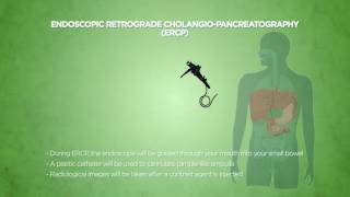 Endoscopic Retrograde Cholangiopancreatography ERCP [upl. by Killion]