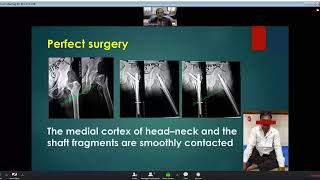 Anteromedial Reduction amp Stabilization of Unstable Trochanteric Fracture Dr Wasudeo Gadegone [upl. by Saref]