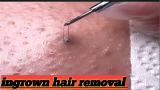 ingrown hair removal 😌 purifiedvideos viral [upl. by Esalb]