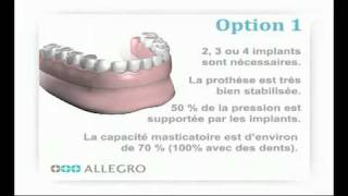 Implants dentaires  Prothèse sur piliers boules [upl. by Darrey]