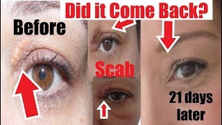 Has Xanthelasma Come Back Before amp After Xanthelasma Removal at Home I show My Scar after Removal [upl. by Elstan168]