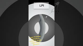 Laser Peripheral Iridotomy in AngleClosure Glaucoma [upl. by Allevon753]