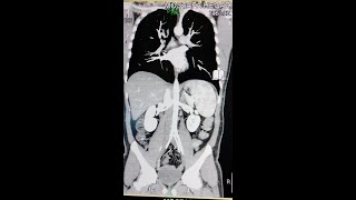 الاشعه المقطعيه علي الشريان الاورطي بالصبغه CT angiography of aorta part 1 [upl. by Oynotna]