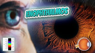 Enophthalmos Your EYEBALLS 👁️👁️💉😳💊🔊💯✅ [upl. by Aniratak]