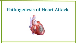 Pathogenesis of myocardial infarction  Heart Attack  Cardiovascular system pathology  Dr Med [upl. by Esmond284]