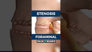 What is foraminal stenosis [upl. by Delija]