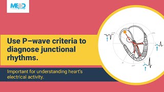 How to diagnose junctional rhythms [upl. by Sharp]