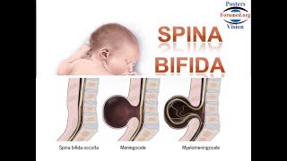 Spina Bifida les Causes et la Prévention par acide folique vitamine B9 [upl. by Anelrad339]