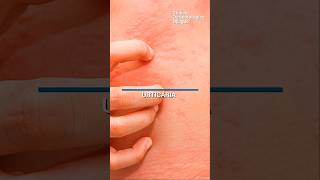 Urticaria dermatologia [upl. by Iliak]