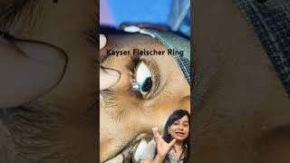 Wilson Disease  Kayser Fleischer Ring Pediatrics clincal case series [upl. by Haropizt653]