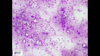 Thyroid cytology  Anaplastic thyroid carcinoma [upl. by Ydok]