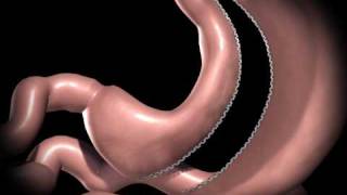 Gastric Sleeve Procedure [upl. by Hogan634]