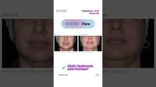 EXION Face Treatments in Zurich  BeforeampAfter Results  SlimLabch [upl. by Marleah]