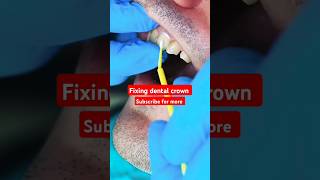 fixing dental crown  dental crown  tooth cap  shorts viral dental asmr [upl. by Ciro]