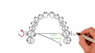 Transpalatal Arch Activations  Essential Biomechanics [upl. by Allecram]