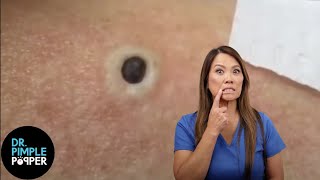 85 Year Old Blackhead Dr Pimple Popper Most Popular Pop of ALL TIME [upl. by Sukram611]