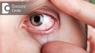 What causes visible red fine lines in eyes  Dr Elankumaran P [upl. by Lucius849]