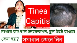 Tinea Capitis চুলের ফাংগাল ইনফেকশন  চুল পড়ে যাওয়া। [upl. by Isaacson]