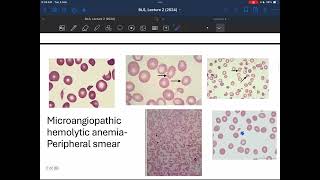 Pathology Immunohemolytic Anemia [upl. by Mashe]