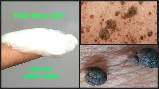 HOW TO GET RID OF SKIN TAGS AT HOME USING 2 INGREDIENTS  BAKING SODA  CASTOR OIL  Khichi Beauty [upl. by Claiborne]