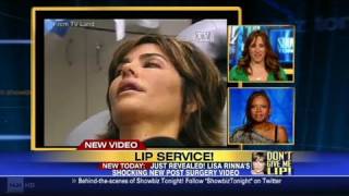 CNN Lisa Rinnas lip trouble [upl. by Aikas]