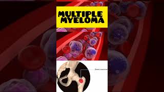 Multiple myeloma multiplemyeloma malayalam cancer hypercalcaemia high calcium genetics [upl. by Einnoc]