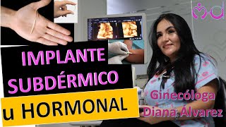 IMPLANTE SUBDERMICO U HORMONAL POR GINECOLOGA DIANA ALVAREZ [upl. by Aniv]